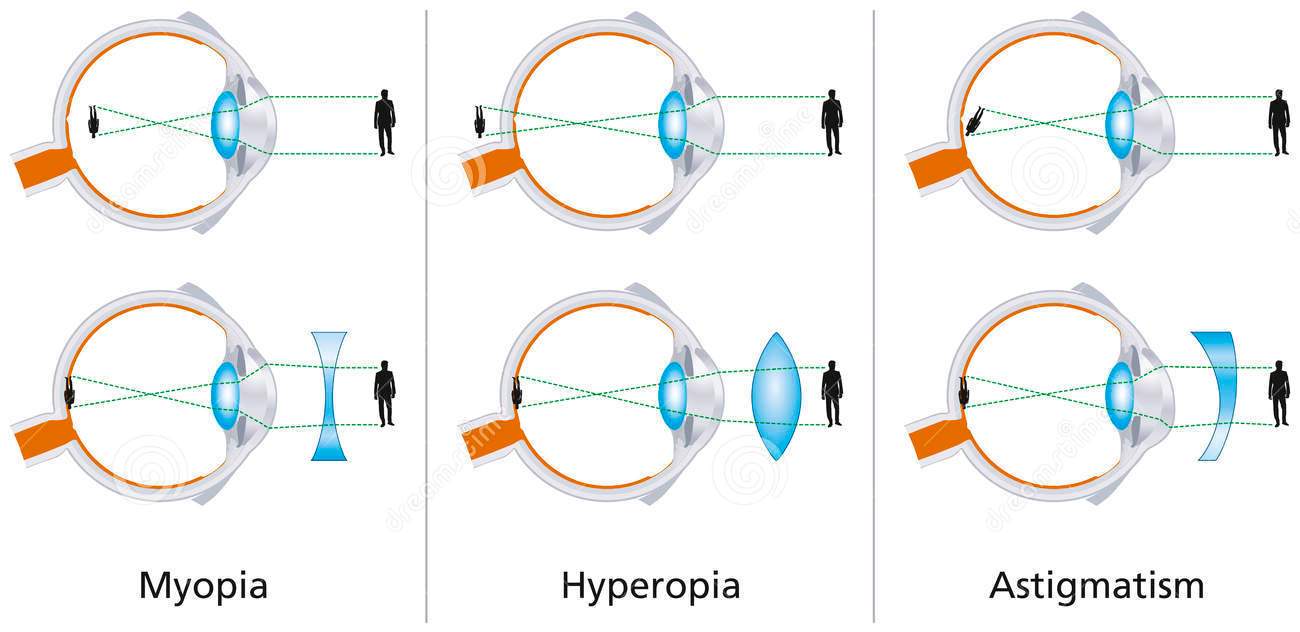 ‘Internal astigmatism’ doesn’t compensate for changes in the eye over time